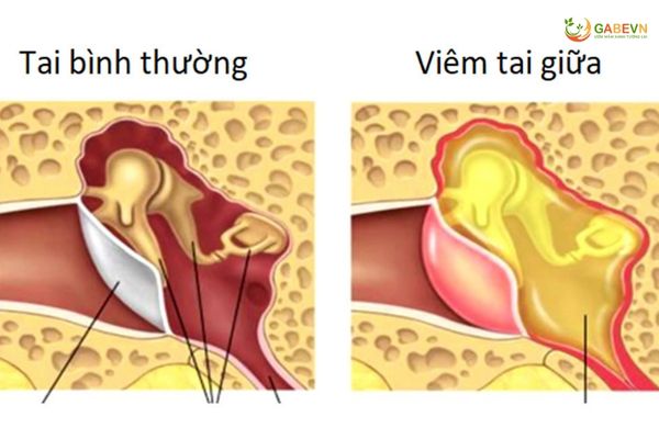 nguyên-nhân-và-dấu-hiệu-nhận-biết-viêm-tai-giữa-ở-trẻ